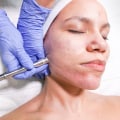 What Clinical Research Organizations Can Teach Us About Better Microdermabrasion in Zurich
