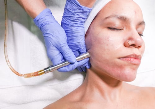What Clinical Research Organizations Can Teach Us About Better Microdermabrasion in Zurich